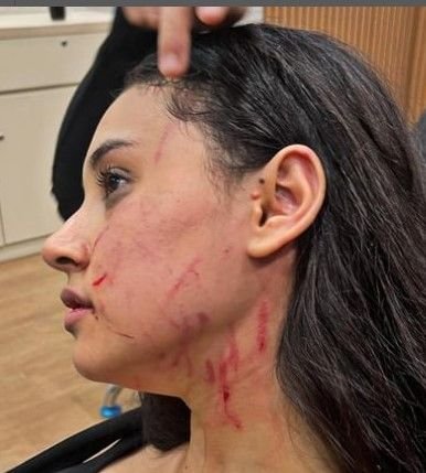 Selebgram Afifah Riyad Alami Dugaan Penganiayaan dari Mantan Kekasih Suaminya: Tubuh Lebam, Wajah Penuh Cakaran