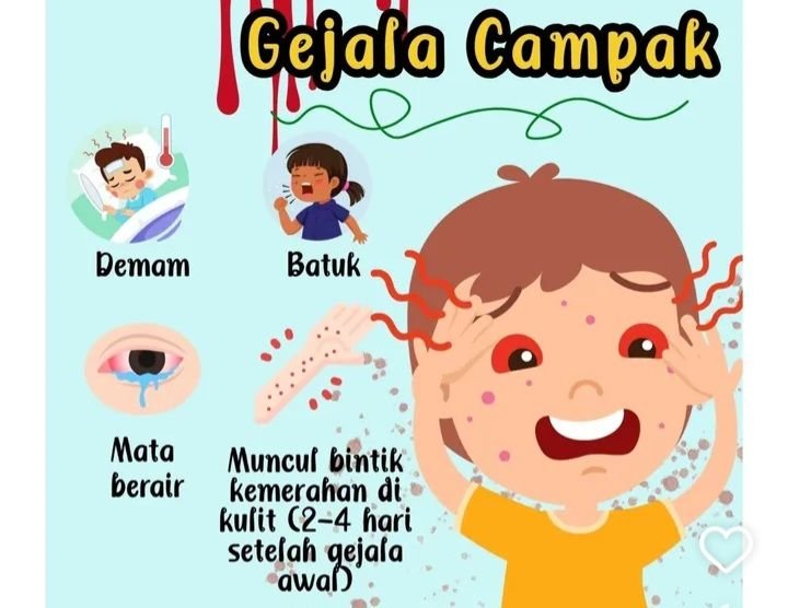 Campak Mewabah di Sumenep,  17 Orang Meninggal