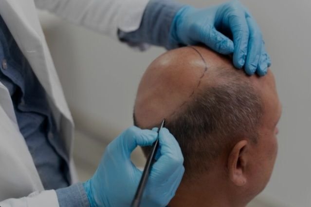 Tidak Semua Transplantasi Rambut Sukses, Ini Faktor Penyebabnya