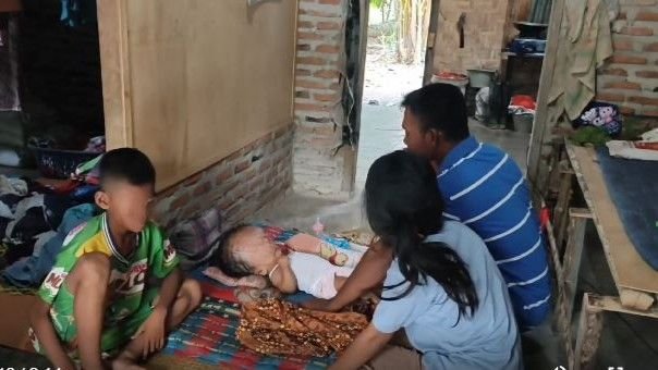 Siti Aisyah Balita Penderita Hidrosefalus di Batubara Butuh Bantuan